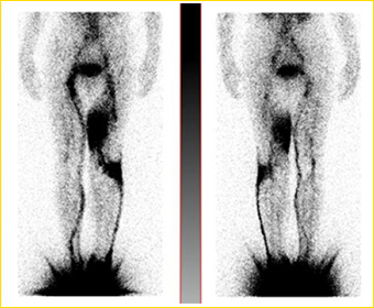 リンパシンチグラフィー