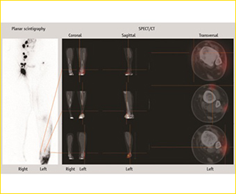 SPECT／CT（スペクト／CT）