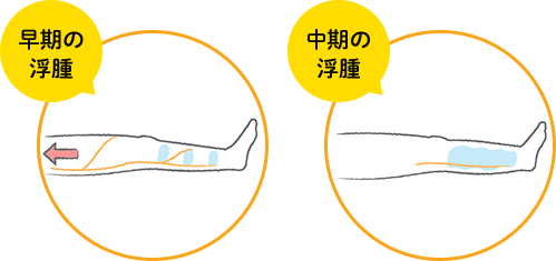 朝になっても続くむくみ