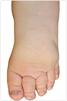 早期浮腫の症例