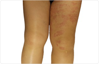 リンパ浮腫の主な症状 リンパ浮腫の総合情報サイト みんなのリンパ浮腫