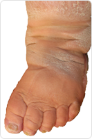 早期浮腫の症例