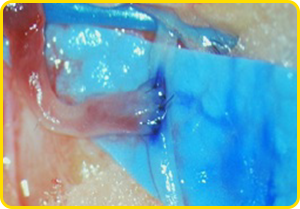 リンパ管静脈吻合術の実例