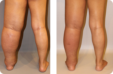 重症例でのリンパ管静脈吻合術の効果